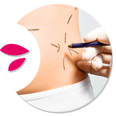 abdominoplastia-circle