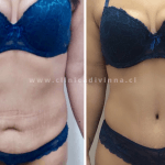 Feliz con mi cirugía combinada de reconstrucción mamaria y de abdominoplastia 1 47