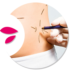 abdominoplastia-circle