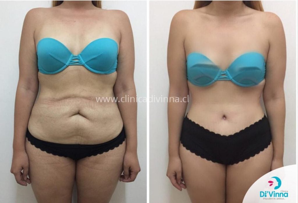 Abdominoplastia antes y despues 3