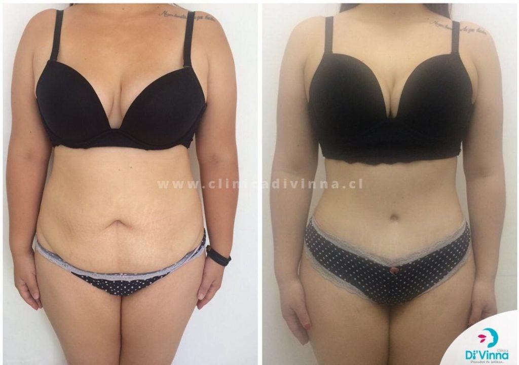 Abdominoplastia antes y despues 2