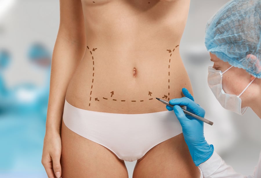 Cual es la diferencia entre abdominoplastia y liposuccion