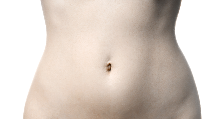 Ombligo contraído después de una abdominoplastia - Spanish Hourglass Tummy  Tuck