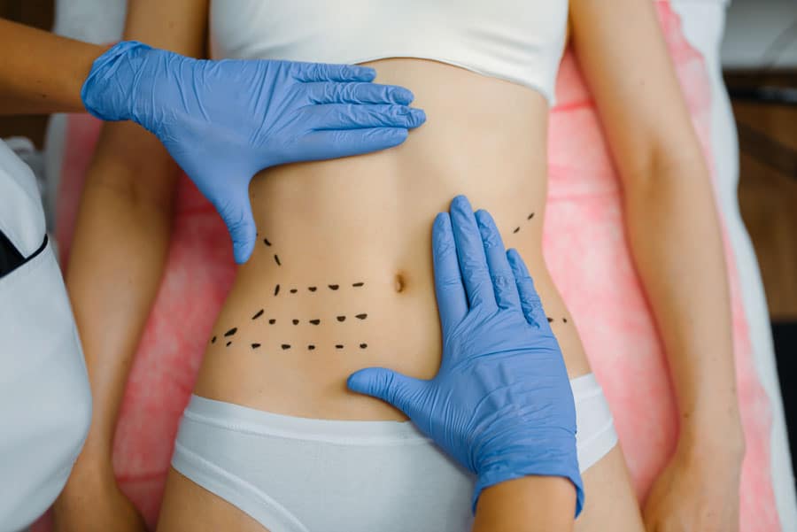 3. Existen varios tipos de abdominoplastia