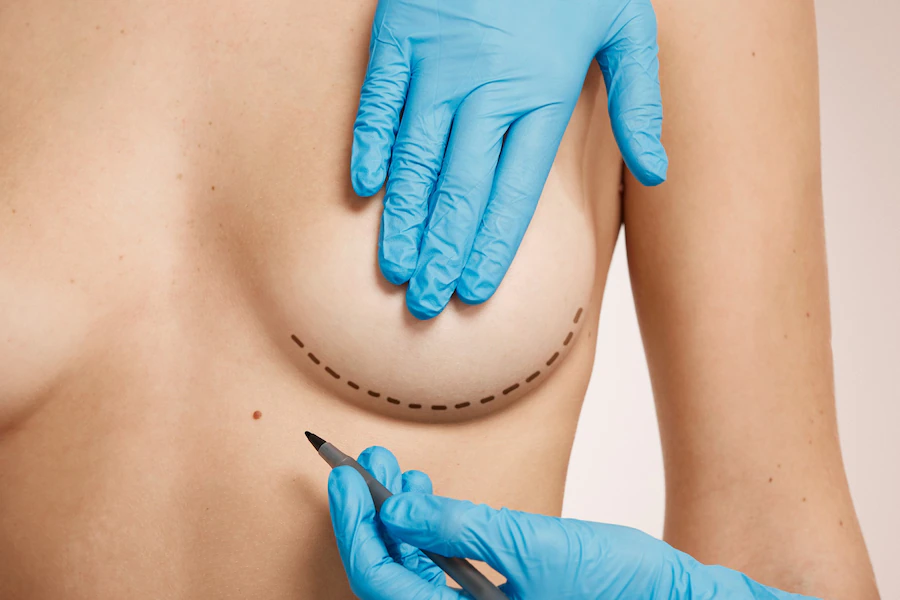Preparación para una mastopexia mujer-marcada-cirugia-estetica_273609-14510