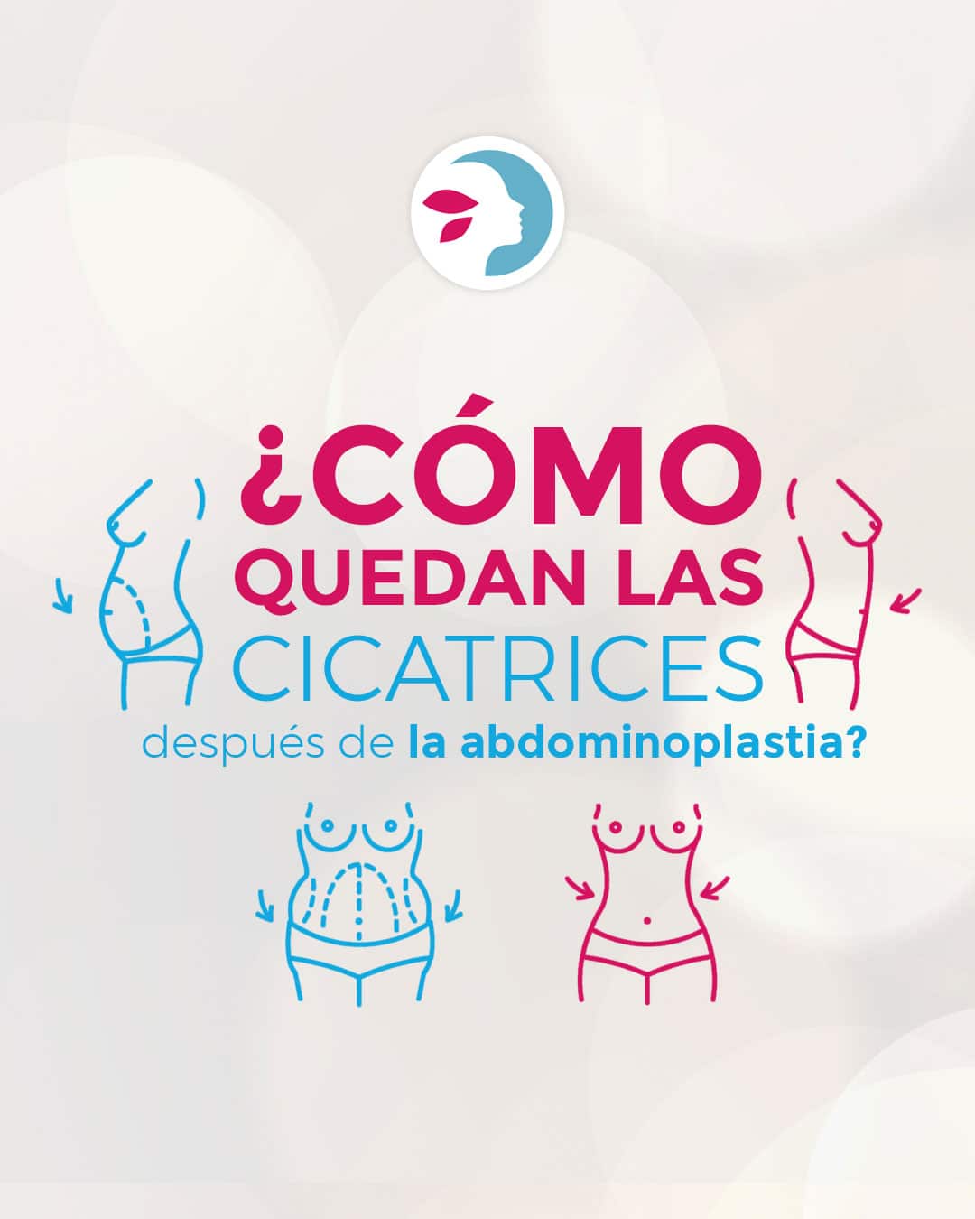 Cicatriz abdominoplastia - Imagen con diseño.