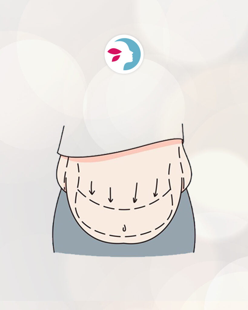 Riesgos despues de una abdominoplastia abdomen
