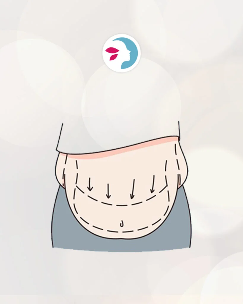 Riesgos despues de una abdominoplastia abdomen