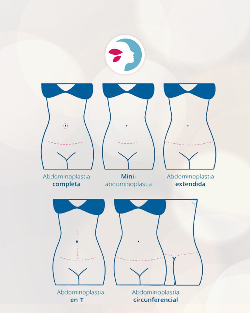 cicatriz abdominoplastia