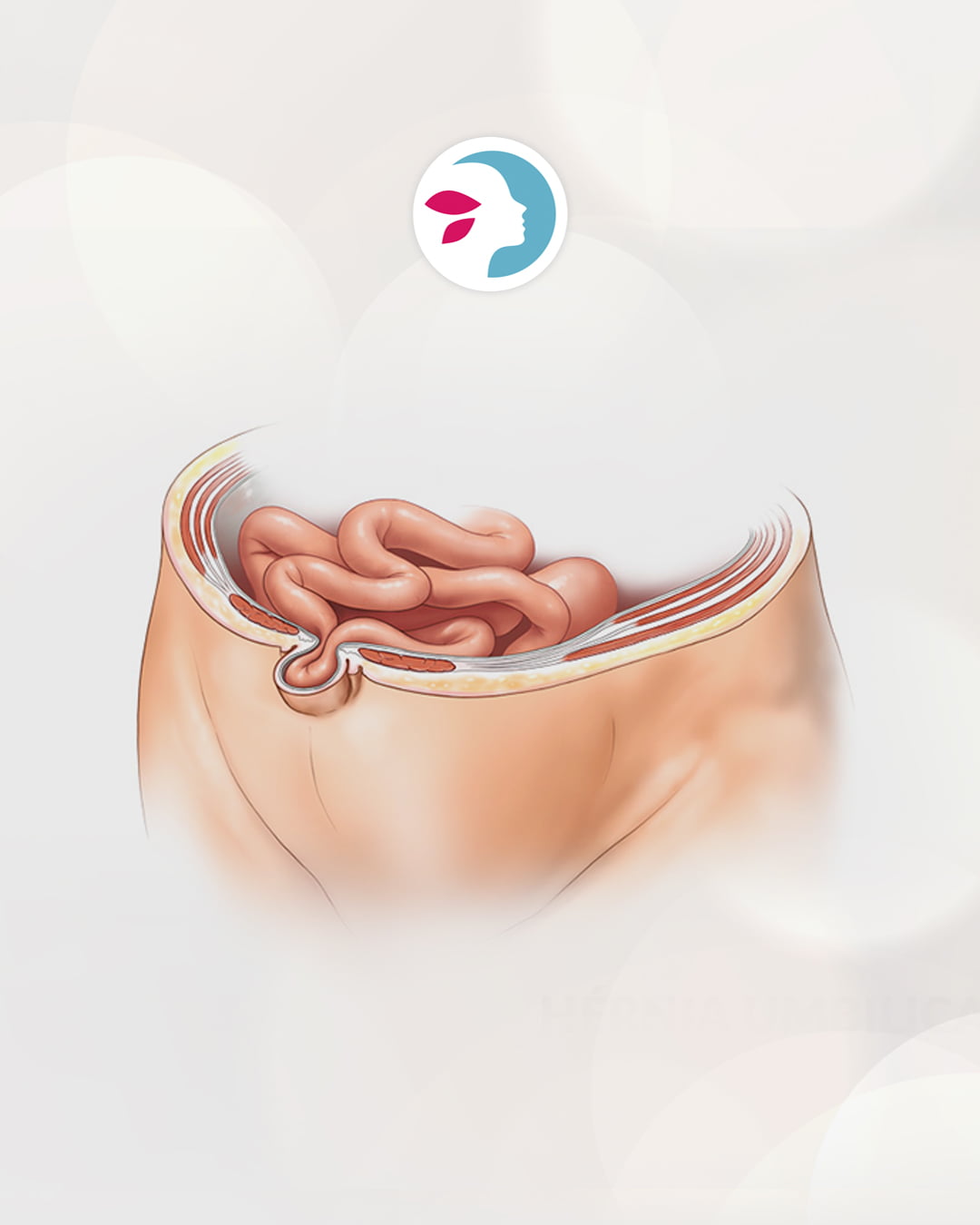 Remodelación de un ombligo con hernia