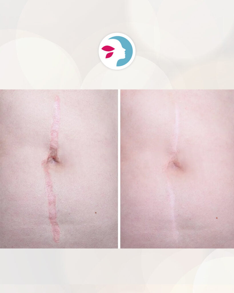 evolucion cicatriz abdominoplastia