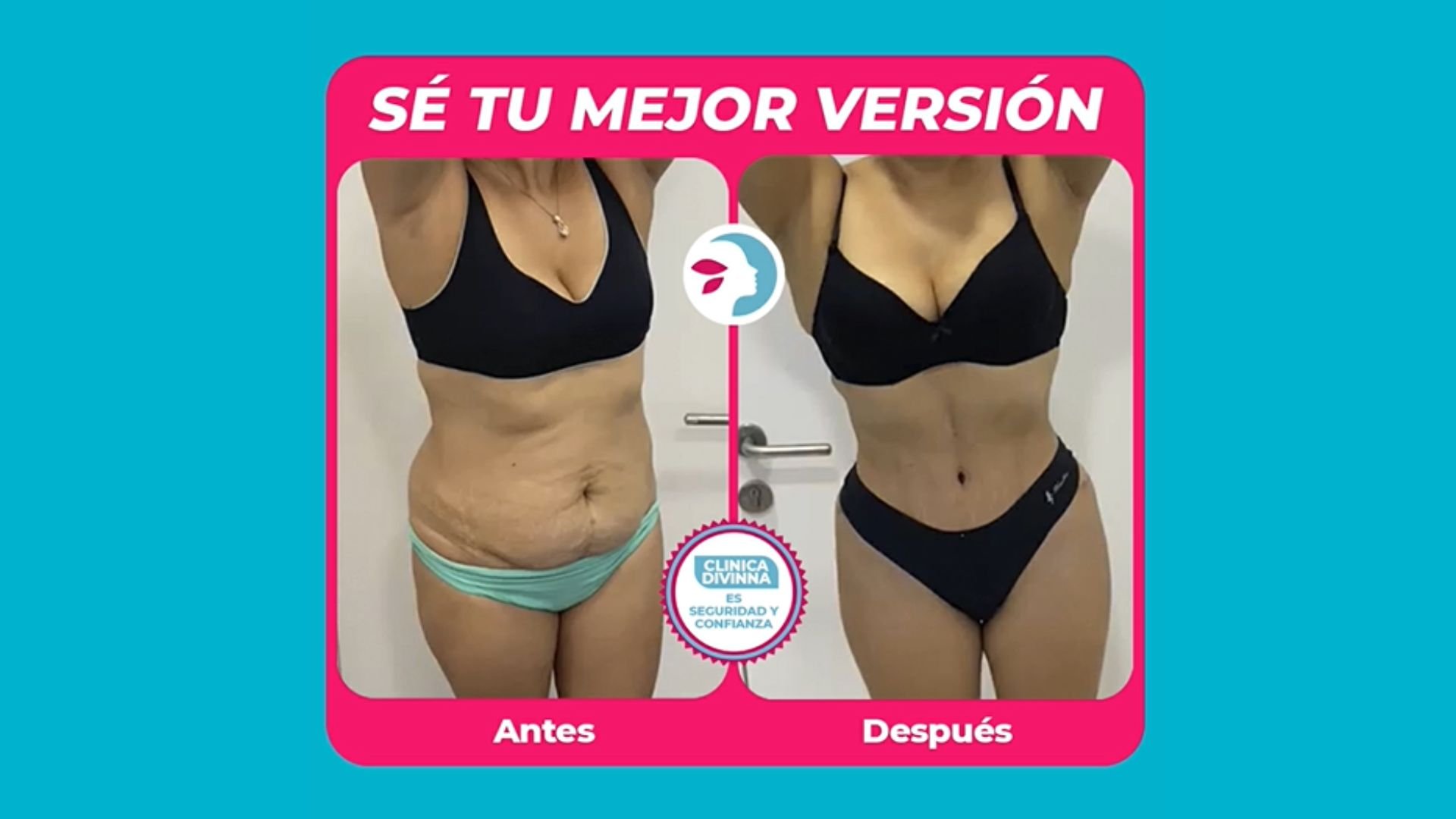 mastopexia 8