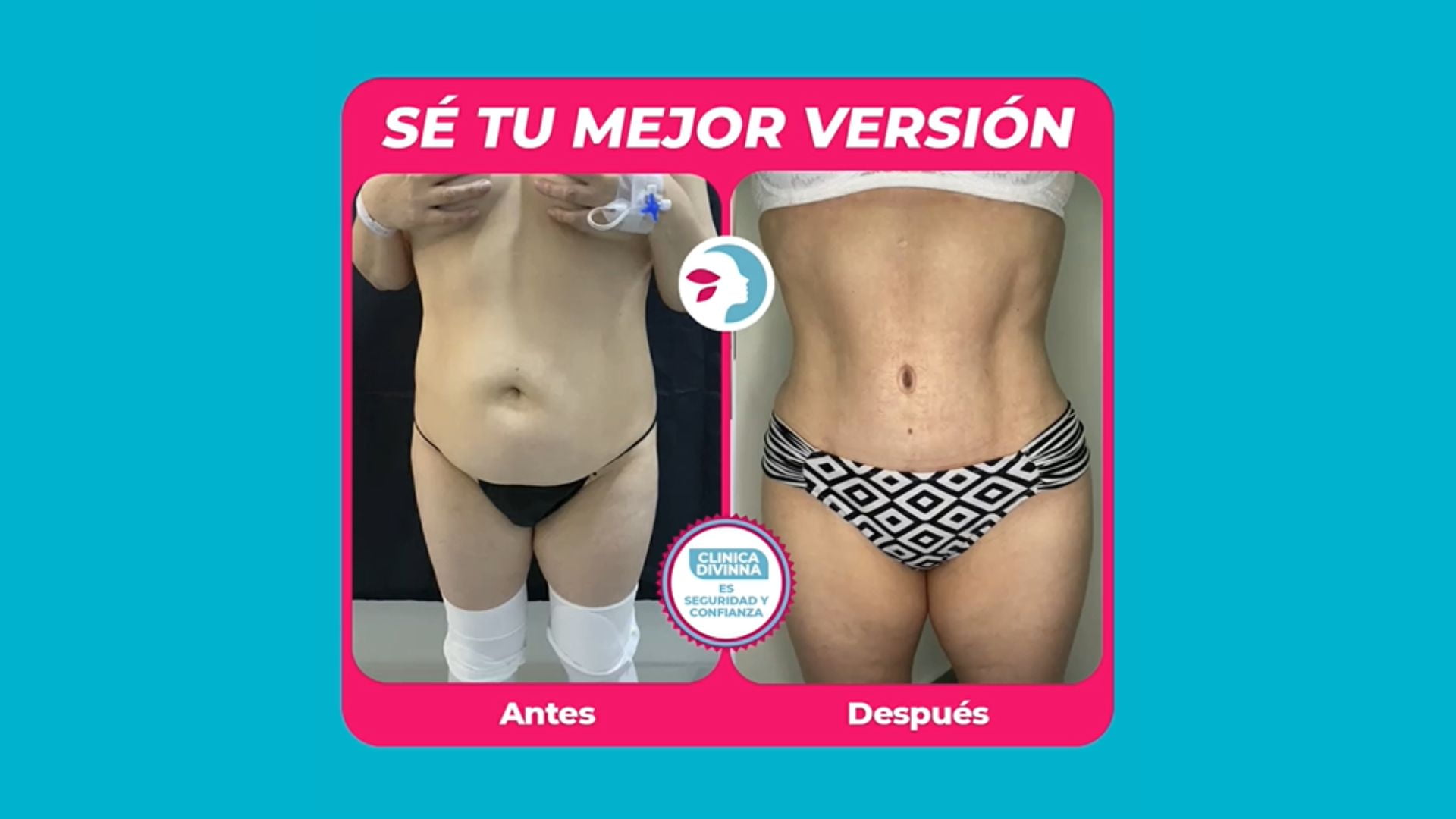 mastopexia 7