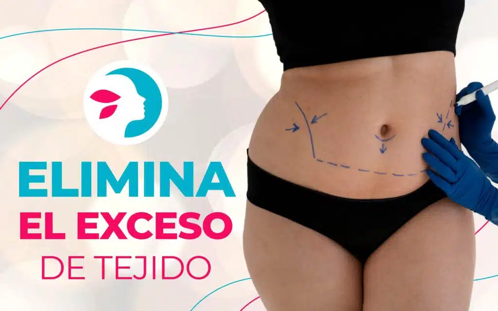 Abdominoplastia