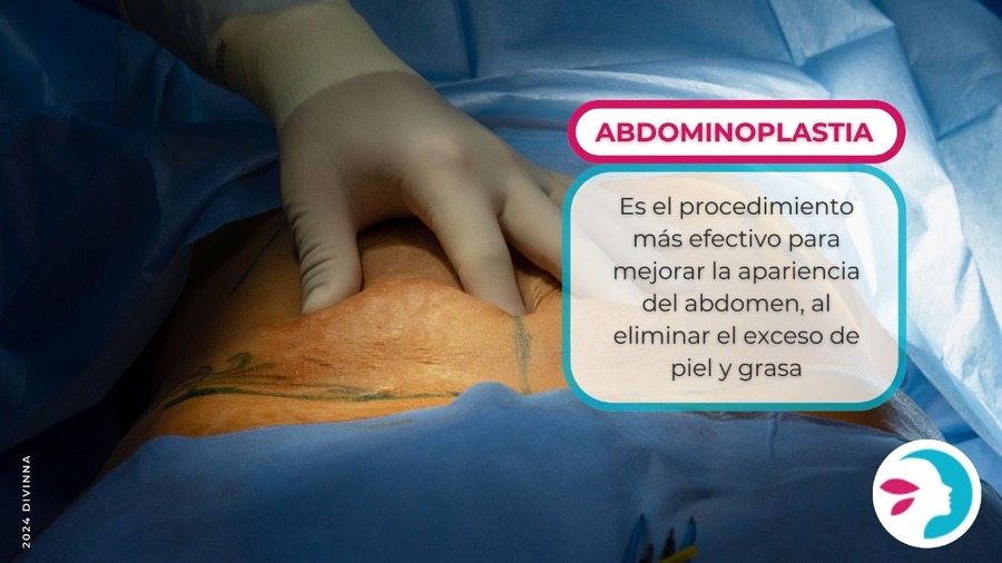 abdominoplastia portada